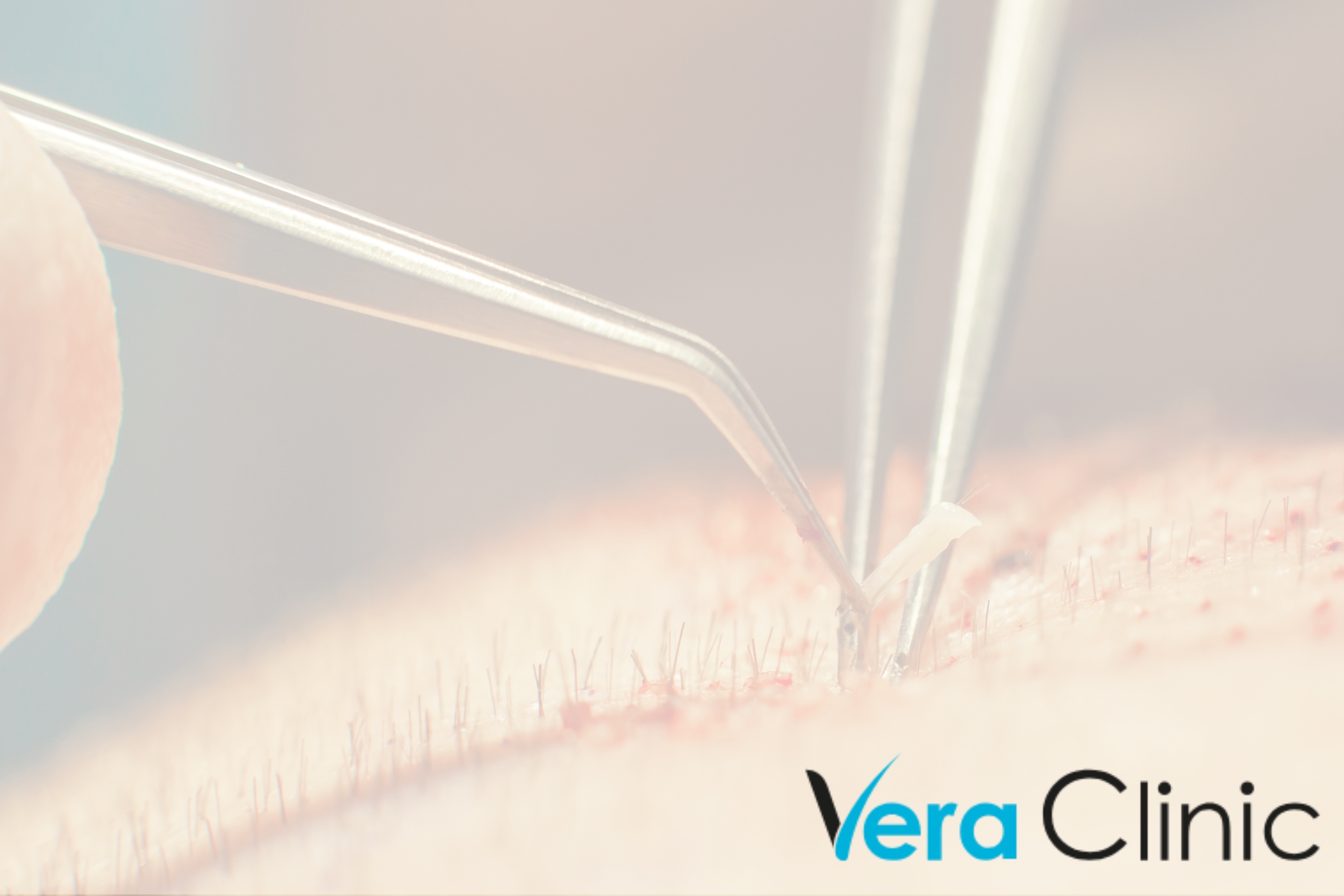 From Local Success To Global Recognition: The Rise Of Turkish Hair Transplant Clinics